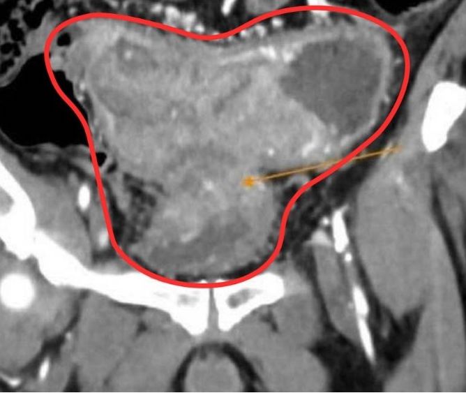 Từ Chối Mổ, Tự Ý Dùng Thuốc Nam, Bệnh Nhân Ung Thư Chuyển Nặng Chọn Thuốc Nam Thay Mổ, Bệnh Nhân Ung Thư Chuyển Nặng Sau 6 Tháng - Ảnh 1.