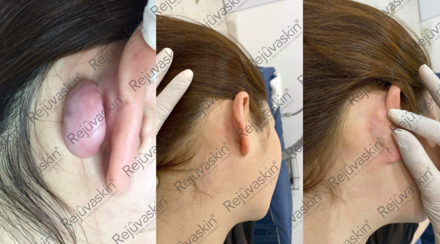 Nâng cấp hiệu quả điều trị sẹo lồi với lời khuyên từ chuyên gia da liễu - Ảnh 1.