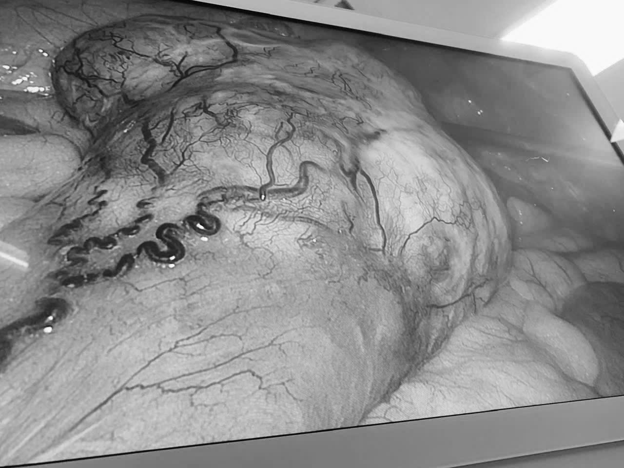 Tưởng Rối Loạn Tiêu Hóa, Đi Khám Phát Hiện Khối U Ruột Và Ung Thư Đại Tràng- Ảnh 2.