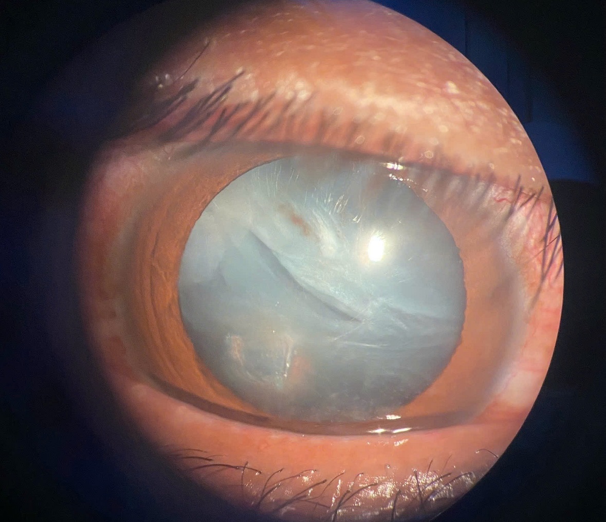 Nam thanh niên bị dây kẽm bắn vào mắt gây rách nhãn cầu - Ảnh 1.