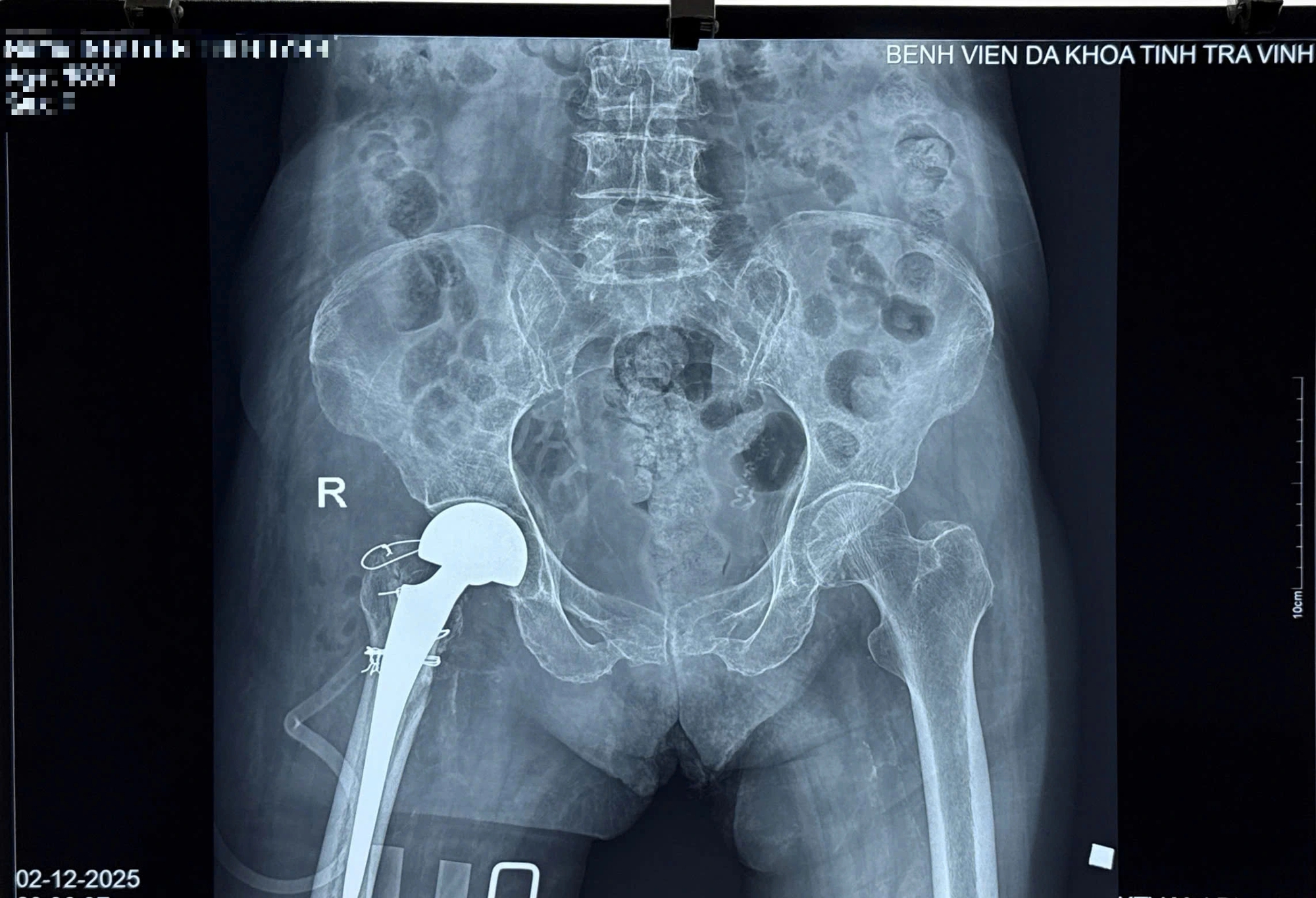 Lần Đầu Tiên Thay Khớp Háng Thành Công Cho Cụ Bà 100 Tuổi - Ảnh 3.