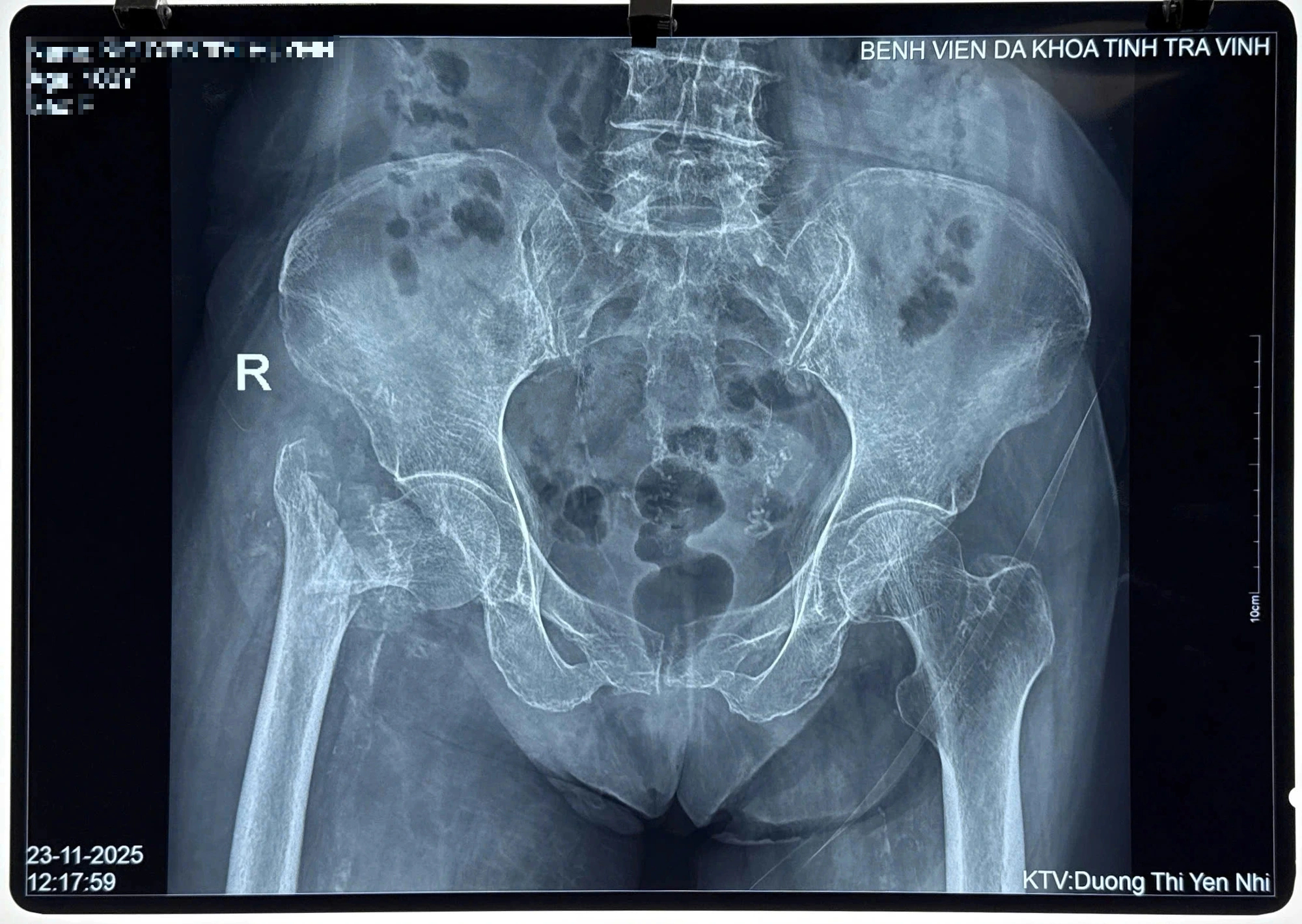 Lần Đầu Tiên Thay Khớp Háng Thành Công Cho Cụ Bà 100 Tuổi - Ảnh 2.