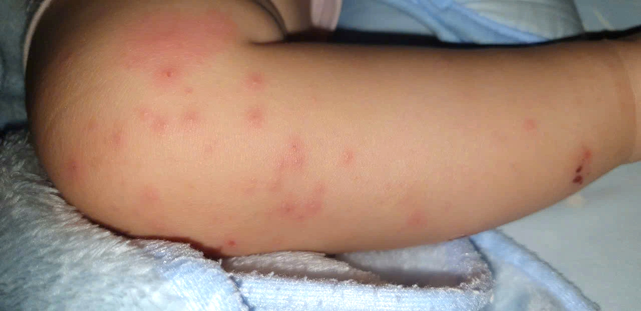 Chủng vi rút gây bệnh tay chân miệng nặng xuất hiện trở lại ở TP.HCM- Ảnh 2. Chủng vi rút gây bệnh tay chân miệng nặng xuất hiện trở lại ở TP.HCM- Ảnh 2.