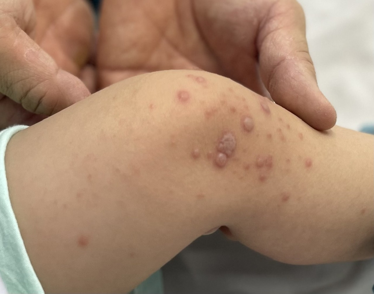 Vi rút EV71 độc lực mạnh nhất gây bệnh tay chân miệng nặng, cần làm gì?- Ảnh 2.