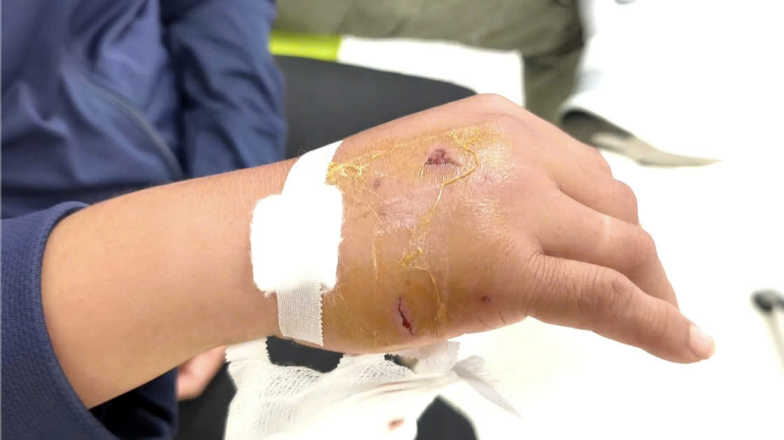 Bác Sĩ Hướng Dẫn Xử Trí Khi Bị Chó Cắn Bác Sĩ Hướng Dẫn Xử Trí Khi Bị Chó Cắn - Ảnh 1.