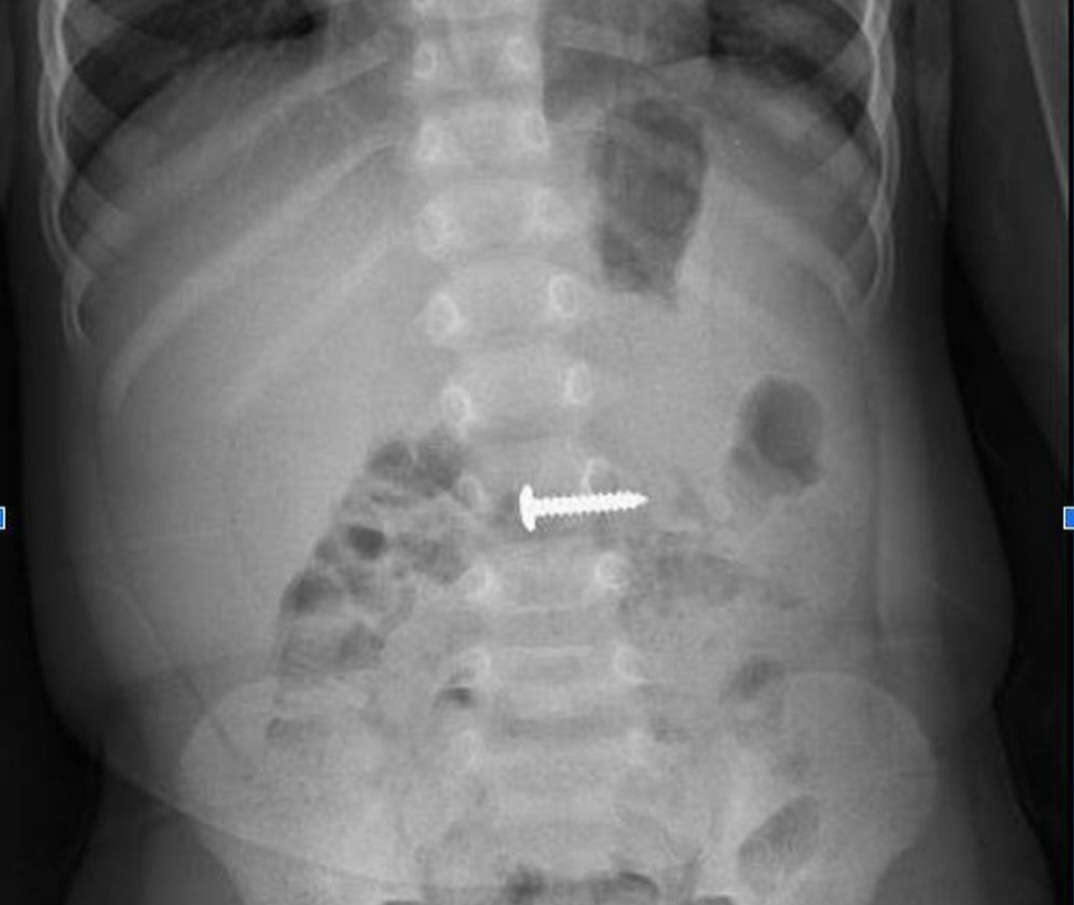 ការដោះវីសចេញពីក្រពះរបស់ទារកអាយុ 34 ខែ - រូបថត 1 ។ Lấy cây đinh vít từ trong bụng cháu bé 34 tháng tuổi - Ảnh 1.