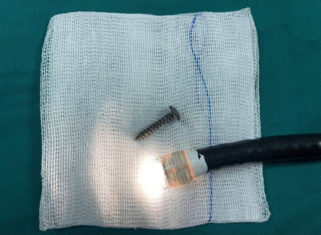 ការដោះវីសចេញពីក្រពះរបស់ទារកអាយុ 34 ខែ - រូបថត 2 ។ Lấy cây đinh vít từ trong bụng cháu bé 34 tháng tuổi - Ảnh 2.