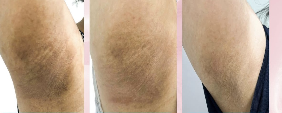 Khổ sở vì tăng tiết mồ hôi- Ảnh 1. Khổ sở vì tăng tiết mồ hôi- Ảnh 1.