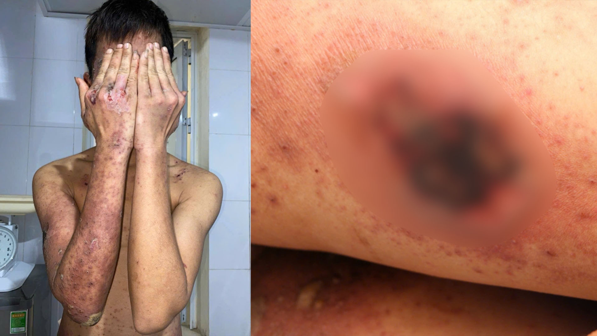 Đắp kiến ba khoang chữa ngứa, nam thanh ni&ecirc;n tổn thương da to&agrave;n th&acirc;n- Ảnh 1.