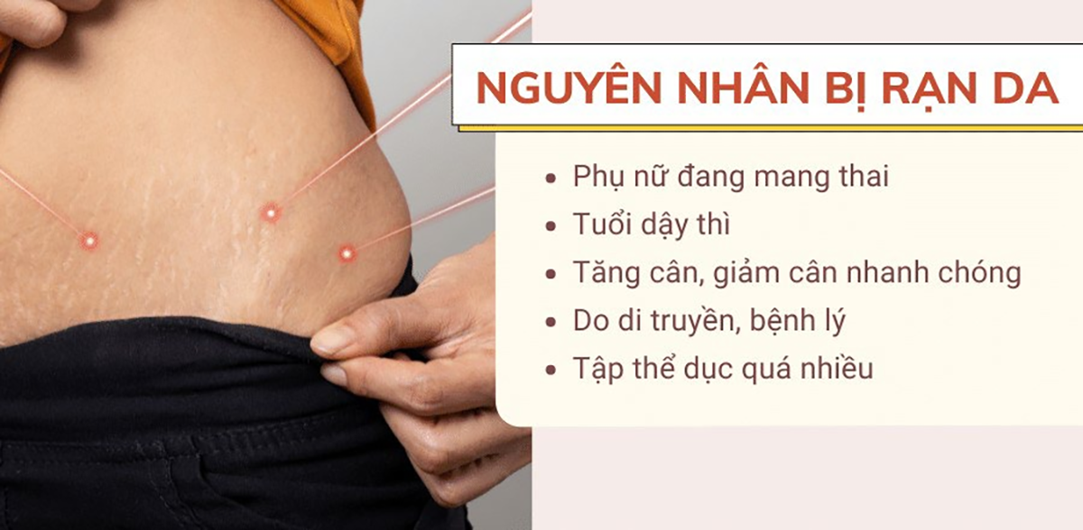 Chữa rạn da hiệu quả: Giải pháp cho làn da mịn màng và tự tin hơn Chữa rạn da hiệu quả: Giải pháp cho làn da mịn màng và tự tin hơn