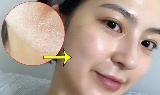 Phục hồi da sau peel chuẩn y khoa chỉ 7 ng&agrave;y da khỏe đẹp, rạng ngời - Ảnh 1.