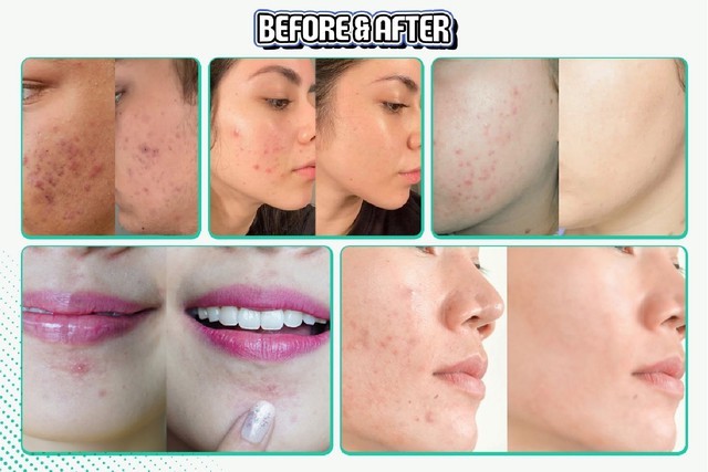 Top 12 kem trị mụn hiệu quả, không để lại thâm- Ảnh 6. Top 12 kem trị mụn hiệu quả, không để lại thâm- Ảnh 6.