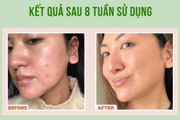 Top 12 kem trị mụn hiệu quả, không để lại thâm- Ảnh 8. Top 12 kem trị mụn hiệu quả, không để lại thâm- Ảnh 8.