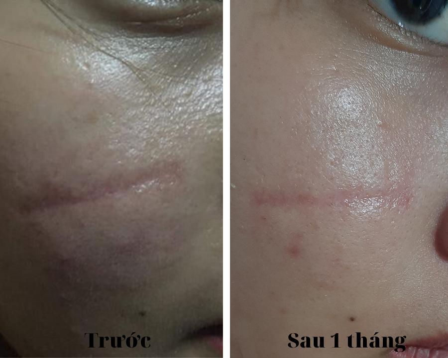 Top 9 kem trị sẹo lõm hiệu quả bất chấp tuổi sẹo mà không cần xâm lấn- Ảnh 1. Top 9 kem trị sẹo lõm hiệu quả bất chấp tuổi sẹo mà không cần xâm lấn- Ảnh 1.
