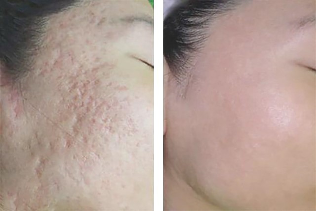 Top 9 kem trị sẹo lõm hiệu quả bất chấp tuổi sẹo mà không cần xâm lấn- Ảnh 4. Top 9 kem trị sẹo lõm hiệu quả bất chấp tuổi sẹo mà không cần xâm lấn- Ảnh 4.