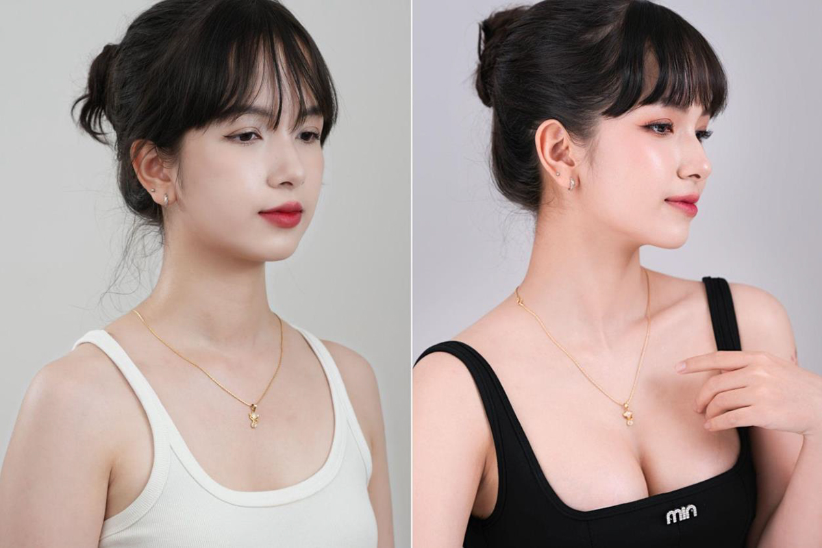 Bệnh viện thẩm mỹ Nam An nâng tầm trải nghiệm phẫu thuật nâng ngực về trong ngày- Ảnh 4. Bệnh viện thẩm mỹ Nam An nâng tầm trải nghiệm phẫu thuật nâng ngực về trong ngày- Ảnh 4.