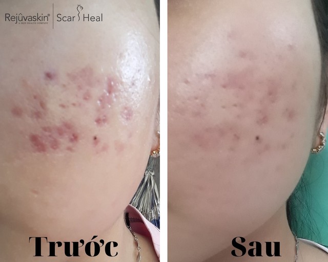 Top 10 kem trị sẹo thâm mụn hiệu quả cả sẹo lâu năm, được tìm mua nhiều- Ảnh 2. Top 10 kem trị sẹo thâm mụn hiệu quả cả sẹo lâu năm, được tìm mua nhiều- Ảnh 2.