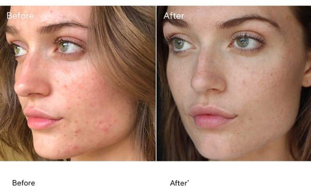 Top 10 kem trị sẹo thâm mụn hiệu quả cả sẹo lâu năm, được tìm mua nhiều- Ảnh 8. Top 10 kem trị sẹo thâm mụn hiệu quả cả sẹo lâu năm, được tìm mua nhiều- Ảnh 8.