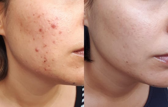 Top 10 kem trị sẹo thâm mụn hiệu quả cả sẹo lâu năm, được tìm mua nhiều- Ảnh 10. Top 10 kem trị sẹo thâm mụn hiệu quả cả sẹo lâu năm, được tìm mua nhiều- Ảnh 10.