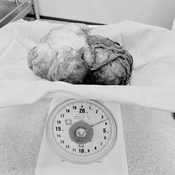 Hơn 2 giờ căng thẳng cắt bỏ khối u xơ tử cung nặng 3,5 kg - Ảnh 2. Hơn 2 giờ căng thẳng cắt bỏ khối u xơ tử cung nặng 3,5 kg - Ảnh 2.