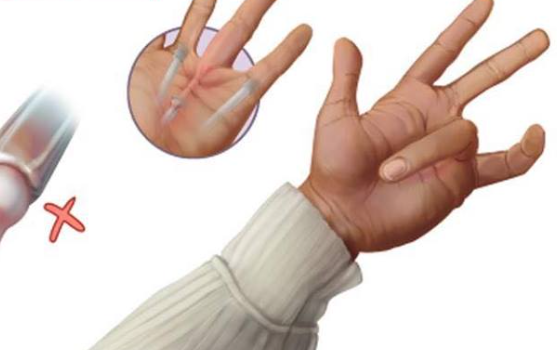Hội chứng 'ngón tay lò xo' là gì? Bác sĩ: Hội chứng 'Ngón tay lò xo' là gì? - Ảnh 1.