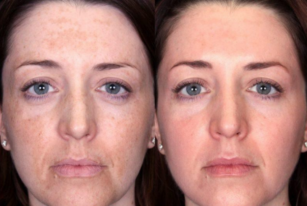 Retinol là gì? 5 tác dụng cho làn da tươi trẻ và cách dùng không kích ứng - Ảnh 16.