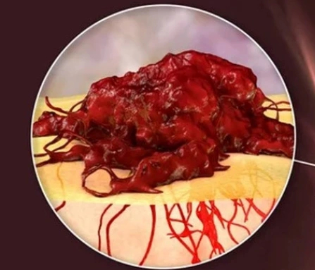 Bệnh nhân phải cắt một phần dương vật do ung thư bị chẩn đoán sai - Ảnh 1.