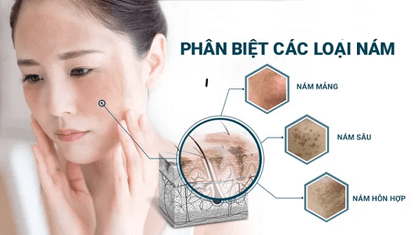 Gợi ý cách trị nám chân sâu, nám mảng... hiệu quả tại nhà không cần xâm lấn- Ảnh 2. Gợi ý cách trị nám chân sâu, nám mảng... hiệu quả tại nhà không cần xâm lấn- Ảnh 2.
