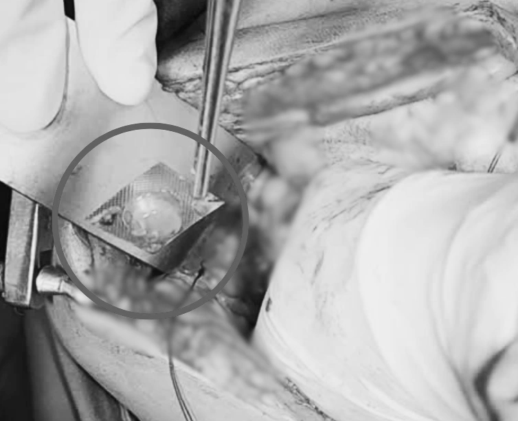 Đau bụng dữ dội nhập viện phát hiện thủng ruột do viên thuốc nguyên vỏ sắt nhọn - Ảnh 1.