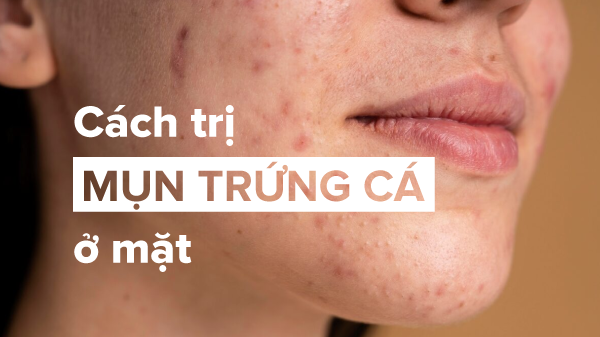 Chi tiết cách trị mụn trứng cá hiệu quả ngay tại nhà từ thể nhẹ tới nặng Chi tiết cách trị mụn trứng cá hiệu quả ngay tại nhà từ thể nhẹ tới nặng