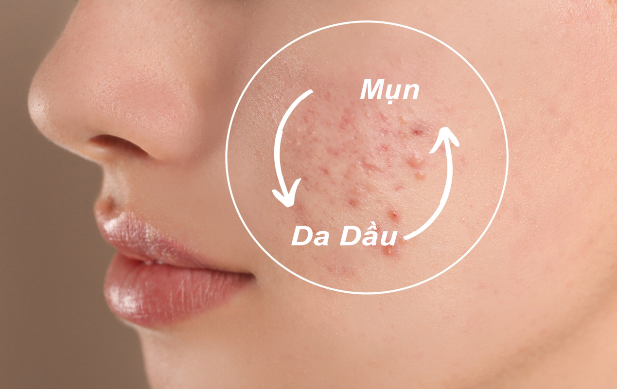 Sữa rửa mặt phù hợp cho da dầu mụn giúp làm sạch dầu thừa mà không gây khô da