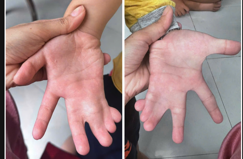 TP.HCM: Phẫu thuật tách bàn tay dính ngón cho bé trai 6 tuổi - Ảnh 1.