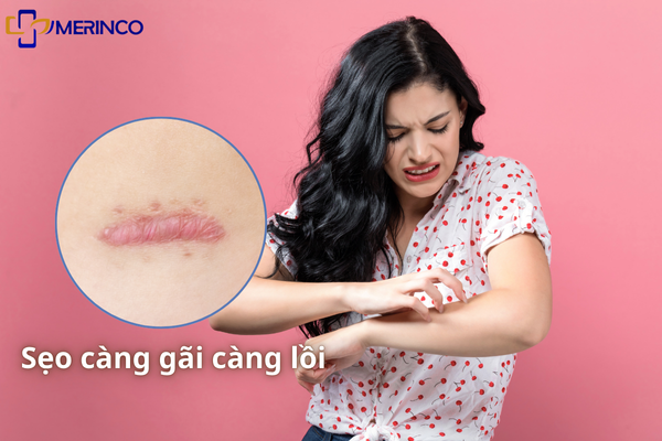 Sẹo lồi hay ngứa do đâu? Có trị hết được không?- Ảnh 1. Sẹo lồi hay ngứa do đâu? Có trị hết được không?- Ảnh 1.