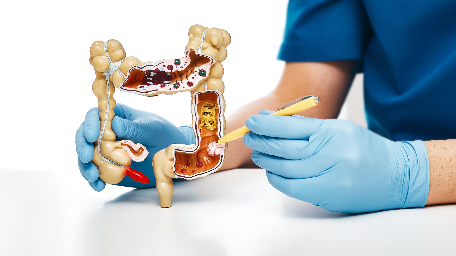 Ăn những thứ này để tránh ung thư đại tràng Ăn những thứ này để tránh ung thư đại tràng