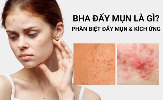 BHA l&agrave; g&igrave;? V&igrave; sao trở th&agrave;nh ng&ocirc;i sao trong c&aacute;c sản phẩm trị mụn? - Ảnh 5.