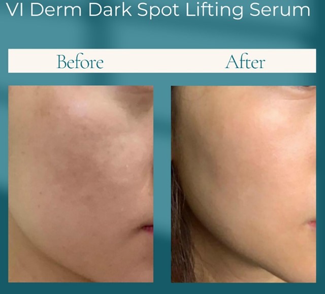 Top 7 kem trị n&aacute;m cho tuổi 40 &lsquo;hồi sinh&rsquo; da tươi trẻ, rạng rỡ đều m&agrave;u- Ảnh 3.