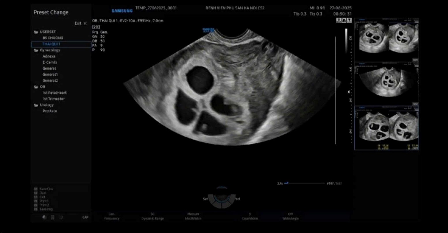 Theo dõi sức khỏe cho sản phụ mang 4 thai tự nhiên - Ảnh 1.