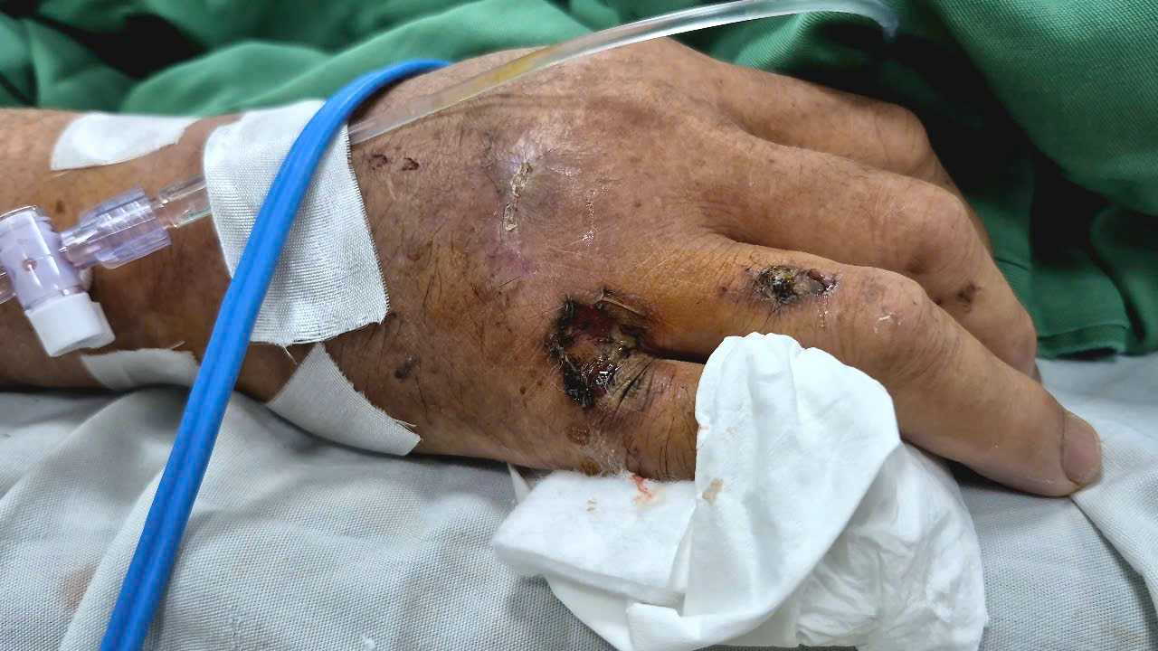 Elektrik çarpması sonucu vücudunun birçok yeri yandı - Fotoğraf 1. Cháy xém nhiều vùng cơ thể do điện giật- Ảnh 1.