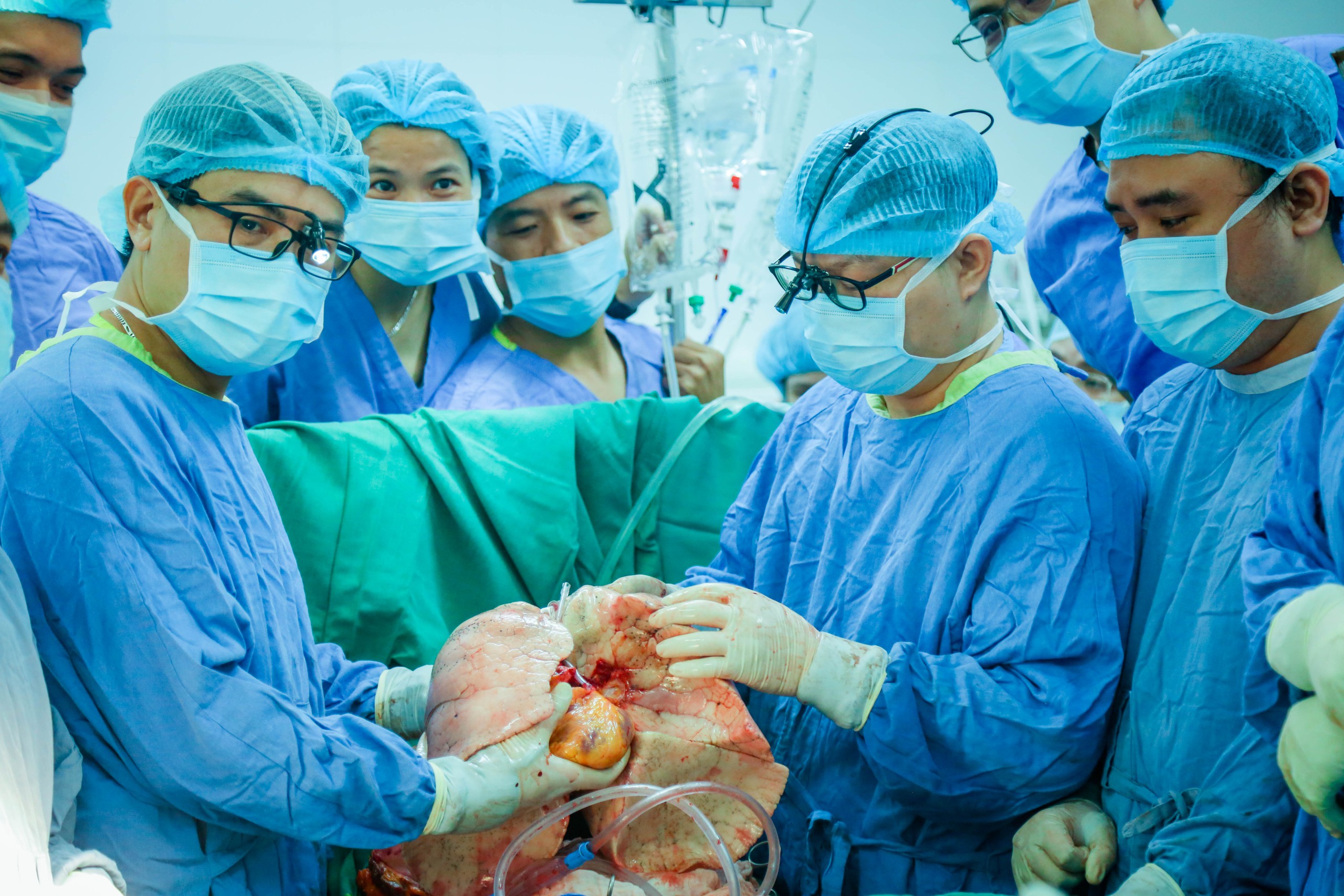 Ca ghép đồng thời tim, phổi đầu tiên thành công tại Việt Nam- Ảnh 1.