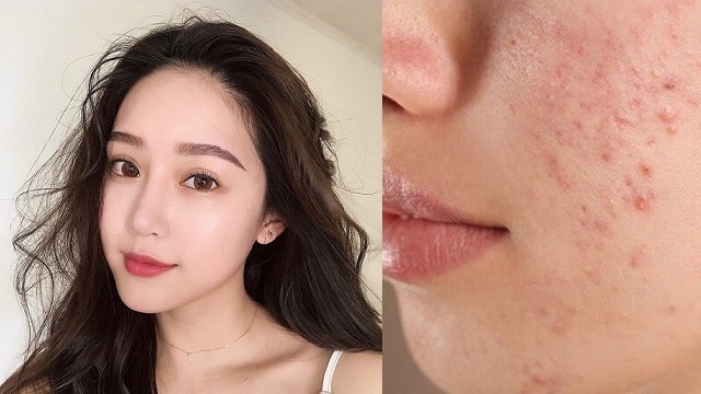 Top 10 kem chống nắng cho da mụn thông thoáng, không bóng nhờn, ngừa mụn hiệu quả- Ảnh 1.
