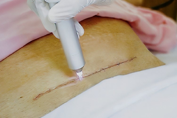 Công nghệ làm mát sau điều trị laser