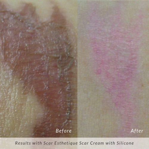 Bí mật xóa sẹo mụn chỉ chuyên gia biết – Scar Esthetique nay đã hé lộ! - Ảnh 3.