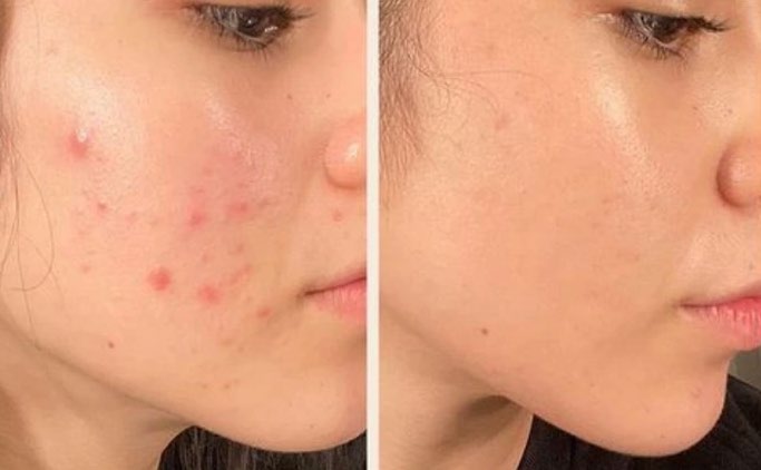 Top 12 kem trị mụn dứt điểm cả mụn thể nặng mà không thâm, không kích ứng