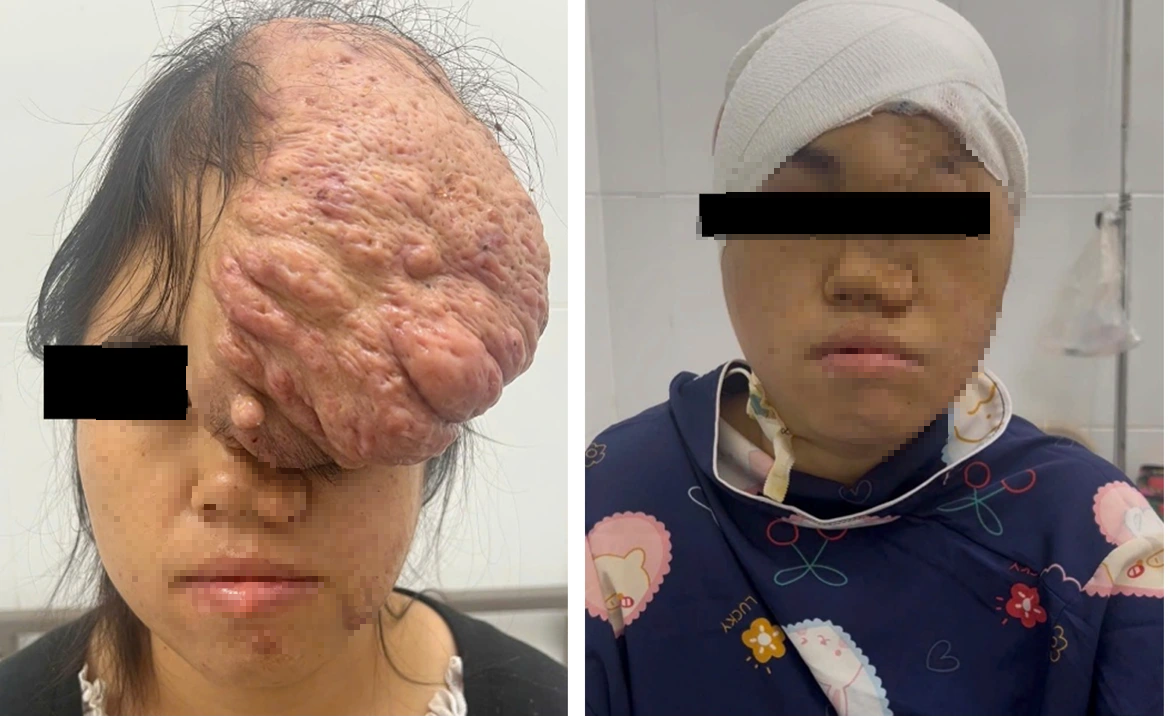 Cô gái Sơn La mang khối u sọ 15 năm được mổ thành công ở Bình Dương - Ảnh 1.