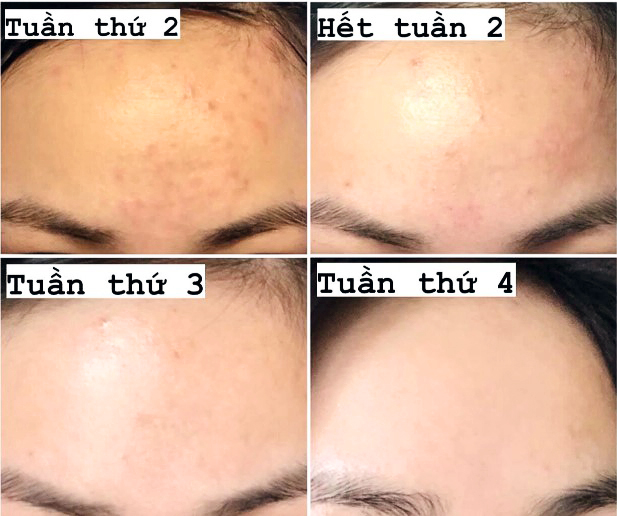 [Review] Top 4 kem giảm mụn ẩn hiệu quả…