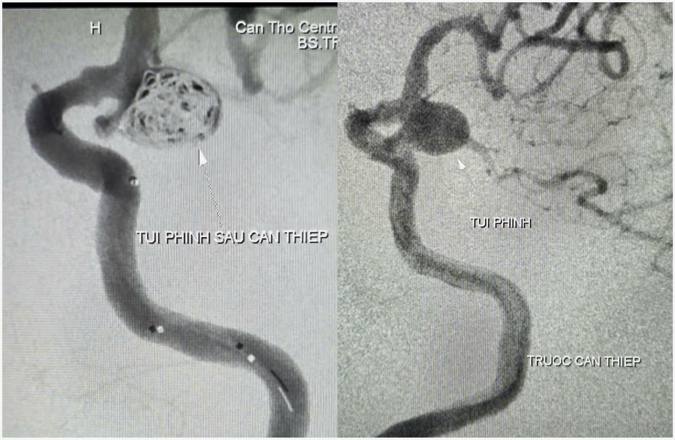Cứu sống cụ bà 90 tuổi bị túi phình mạch máu não nguy kịch - Ảnh 3.