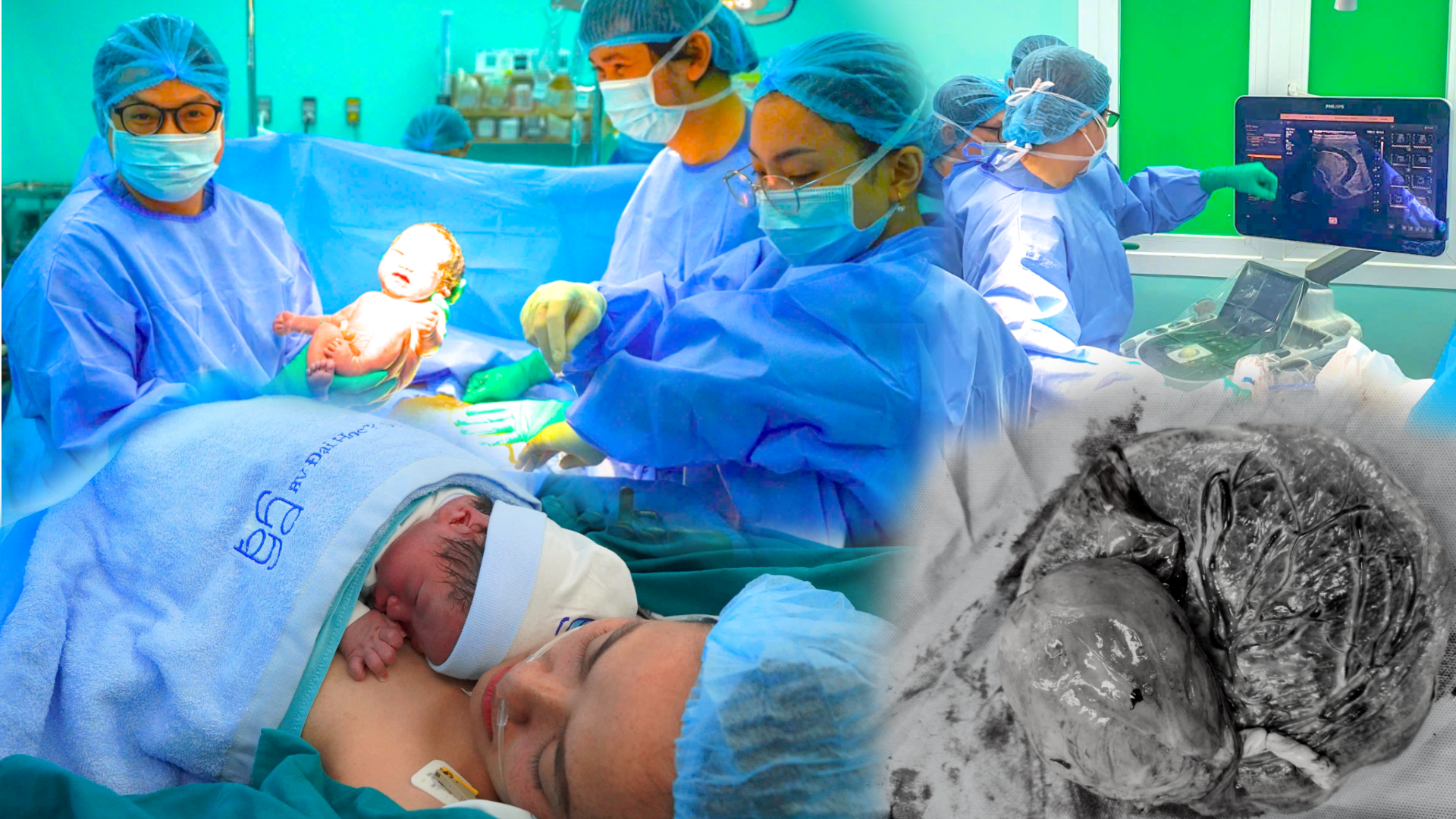 Ca can thiệp bào thai cực hiếm, cứu thai nhi mắc khối u nhau thai khổng lồ- Ảnh 1.