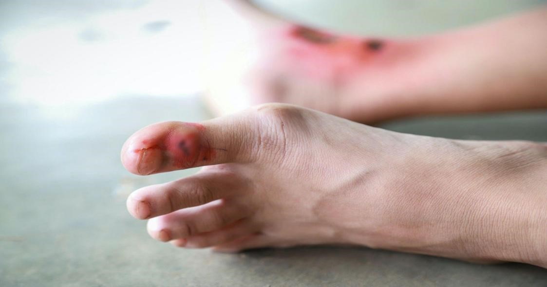 Bệnh nhân nam suýt mất mạng chỉ vì một vết xước nhỏ ở chân- Ảnh 1. Bệnh nhân nam suýt mất mạng chỉ vì một vết xước nhỏ ở chân- Ảnh 1.