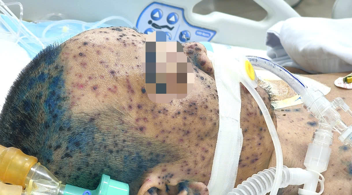 Người Đàn Ông Nguy Kịch Sau Khi Tự Dùng Thuốc, Truyền Dịch Điều Trị Thủy Đậu- Ảnh 1.