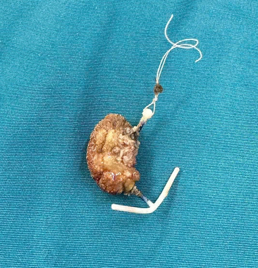 Vòng tránh thai được đặt cách đây 22 năm đã 'đi" lạc vào bàng quang  - Ảnh 1.